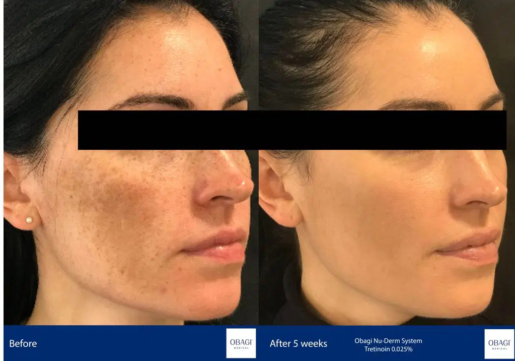 Obagi Complete Skin Transformation Kit