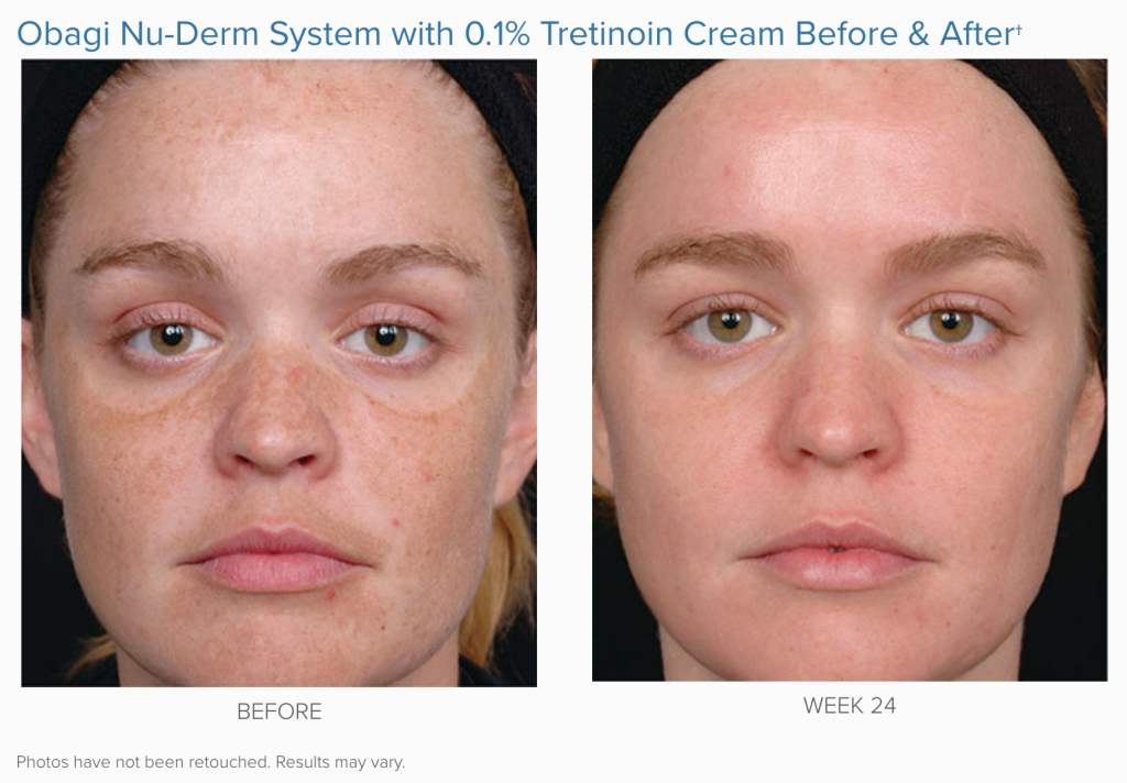 Obagi Complete Skin Transformation Kit