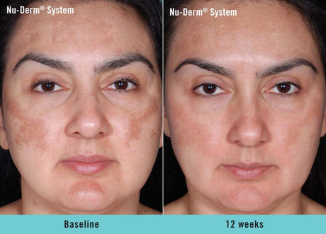 Obagi Complete Skin Transformation Kit